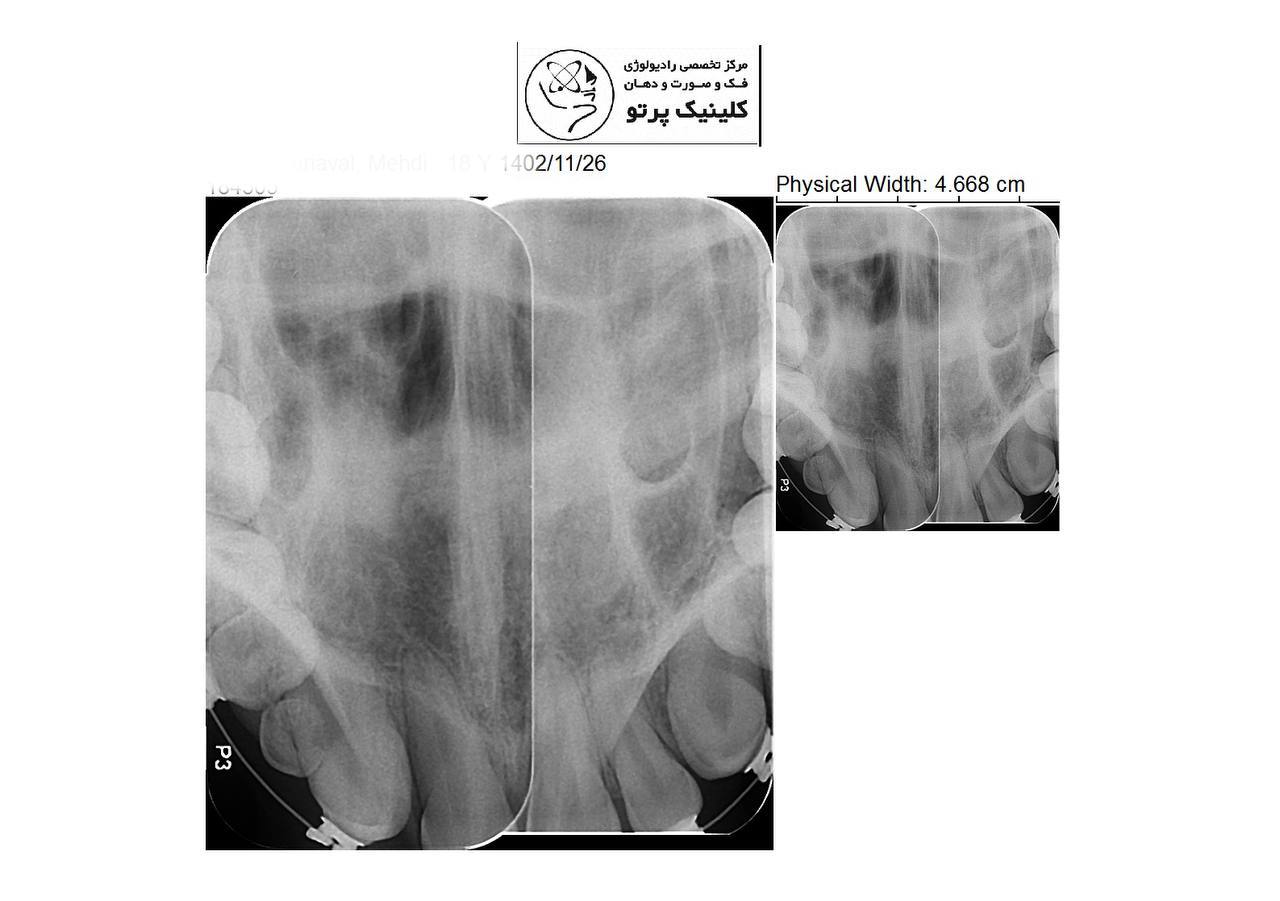 رادیوگرافی اکلوزال