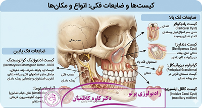 کیست فکی چیست؟ نقش CBCT در تشخیص دقیق و درمان کیست‌های فک و دندان