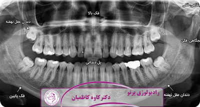 دندان عقل نهفته چیست؟ بررسی کامل علائم، خطرات و نقش CBCT در تشخیص دقیق